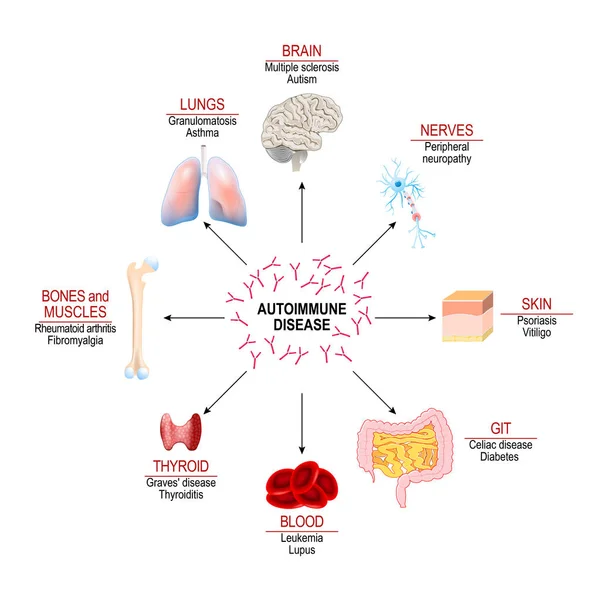 Tissues Human Body Affected Autoimmune Attack Vector Diagram Your Design — Stock Vector