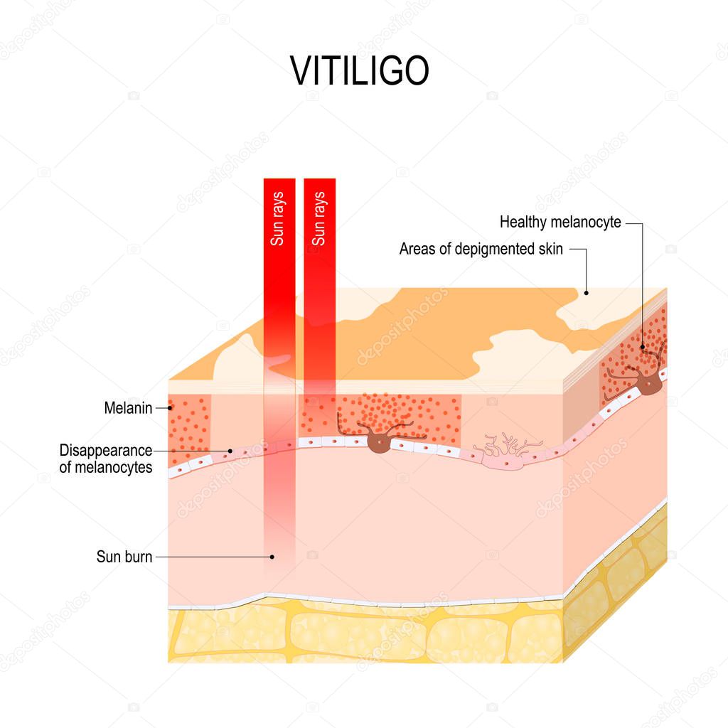 Vitiligo. Is a skin condition characterized by portions of the skin losing their pigment. It occurs when skin pigment cells (melanocytes) die or are unable to function. Vector diagram for educational, medical, biological and science use