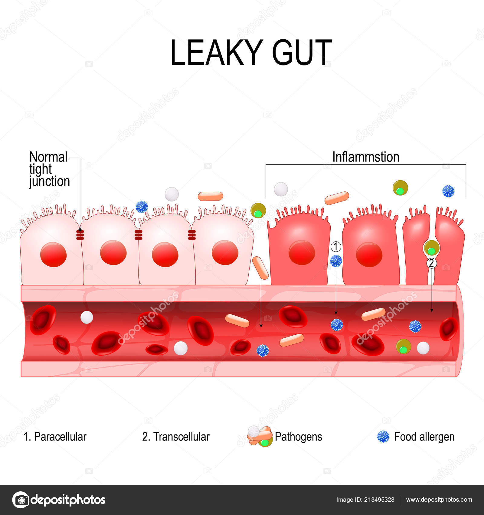 Agujereado intestino