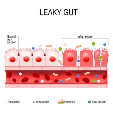 leaky gut. cells on gut lining held tightly together. in intestine with celiac disease and gluten sensitivity these tight junctions come apart. autoimmune disorder. Vector diagram for educational, medical, biological and science use clipart