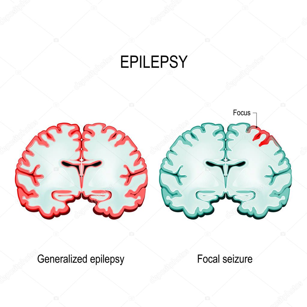 Epilepsy is a condition characterized by recurrent and unpredictable seizures. Brain Sections. primary generalized epilepsy and focal seizures. Vector diagram for educational, medical, biological and science use
