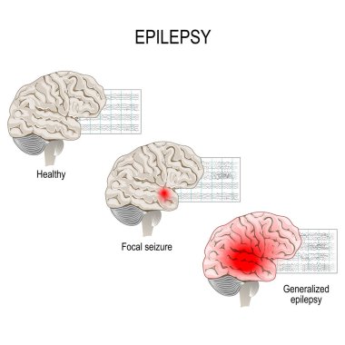 Epilepsi tarafından tekrarlayan ve öngörülemeyen nöbetleri ile karakterize bir durumdur. İnsan beyni. EEG sağlıklı beyin ve Epilepsi nöbeti. birincil epilepsi ve fokal nöbetler jeneralize. Bilim, biyolojik ve tıbbi kullanım için vektör diyagramı