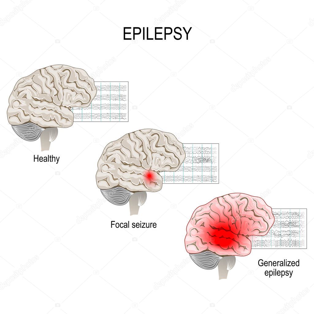 Epilepsy is a condition characterized by recurrent and unpredictable seizures. Human brain. EEG of healthy brain and epileptic seizure. primary generalized epilepsy and focal seizures. Vector diagram for medical, biological and science use
