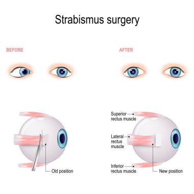 Strabismus Surgery. Eye muscle recession. Extraocular Muscle Anatomy. surgeon alters the attachment site of the muscle, cutting the muscle from the surface of the eye and reattaching it further back on the eyeball, away from the front of the eye. clipart