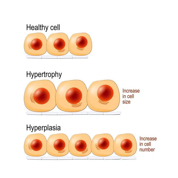 Нормальные Клетки Гипертрофия Увеличение Размера Клеток Гиперплазия Результат Увеличения Количества — стоковый вектор