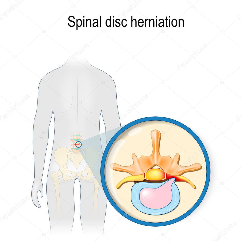 Spinal disc herniation. Back pain. Human silhouette with highlighted (red color) lumbar spine and Pelvis. Prolapse of intervertebral disc close-up. Vector illustration for your design, educational, biology, scientific, and medical use.