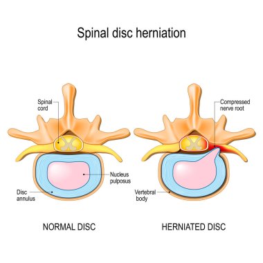 Omurilik disk herniasyonu. Sırt ağrısı. Normal disk ve servikal vertebra omurga disk herniasyonu. Tasarım, eğitim, biyoloji, bilimsel ve tıbbi kullanım için illüstrasyon vektör.