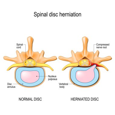 Spinal disc herniation. Back pain. Normal disc and spinal disc herniation in cervical vertebrae. Vector illustration for your design, educational, biology, scientific, and medical use.