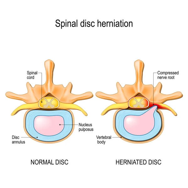 Spinal disc herniation. Back pain. Normal disc and spinal disc herniation in cervical vertebrae. Vector illustration for your design, educational, biology, scientific, and medical use. — Stock Illustration Spinal Disc Herniation Back Pain Normal Disc Spinal Disc Herniation Stock Vector