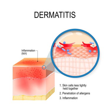 Atopik Dermatit (Atopik Egzama). Dermatit ile insan derisi kesiti. Cilt hücrelerinin ve alerjenleri penetrasyon yakın çekim. Vektör çizim tıbbi, biyolojik ve eğitim kullanmak için
