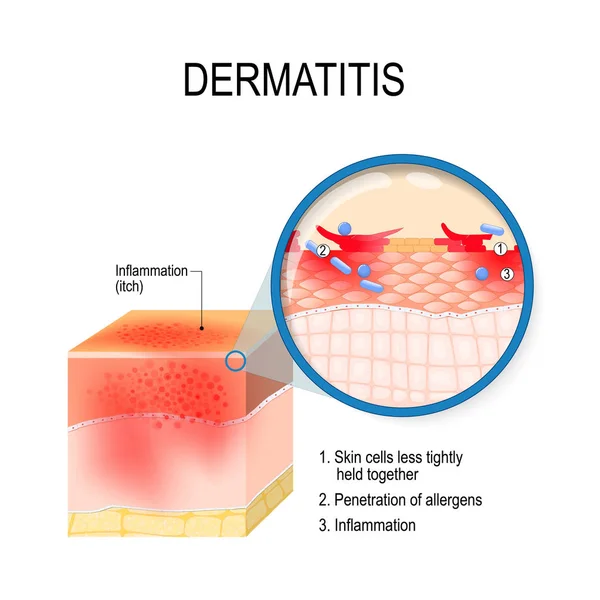 アトピー性皮膚炎 アトピー 皮膚炎と皮膚の断面図 皮膚細胞 およびアレルゲンの侵入のクローズ アップ 生物学的 および教育使用のためのベクトル図 — ストックベクタ