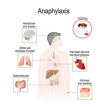 Anaphylaxis is a serious allergic reaction that may cause death. Human silhouette with highlighted internal organs. Vector illustration for medical, biological, and educational use clipart