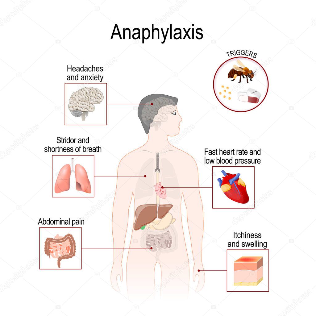 Anaphylaxis is a serious allergic reaction that may cause death. Human silhouette with highlighted internal organs. Vector illustration for medical, biological, and educational use