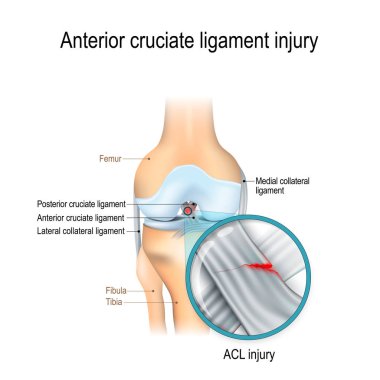 Ön çapraz bağ yaralanması. ortak anatomisi. Biyoloji, tıp, bilim ve eğitim için vektör çizim
