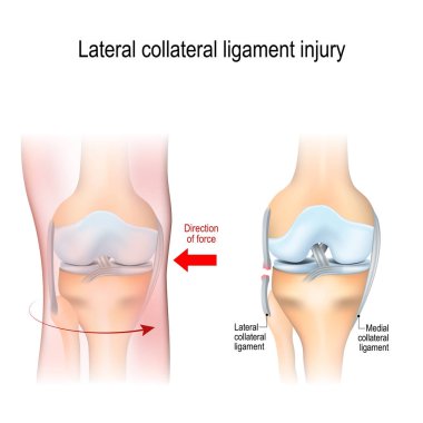 Fibular kollateral bağ yaralanması. ortak anatomisi. Biyoloji, tıp, bilim ve eğitim için vektör çizim