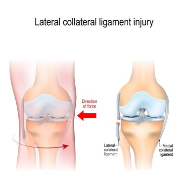 Fibular collateral ligament injury. joint anatomy. Vector illustration for biological, medical, science and educational use clipart