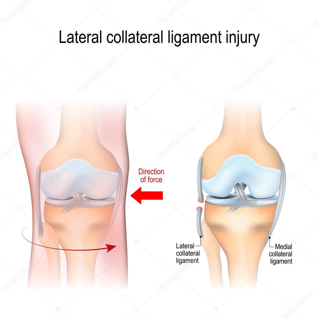 Fibular collateral ligament injury. joint anatomy. Vector illustration for biological, medical, science and educational use