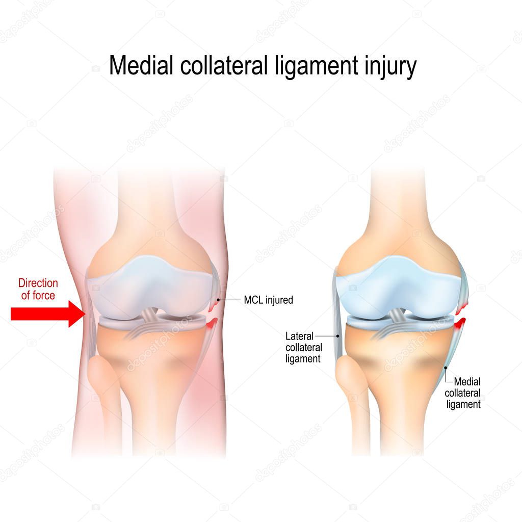 Medial knee injuries. joint anatomy. Vector illustration for biological, medical, science and educational use
