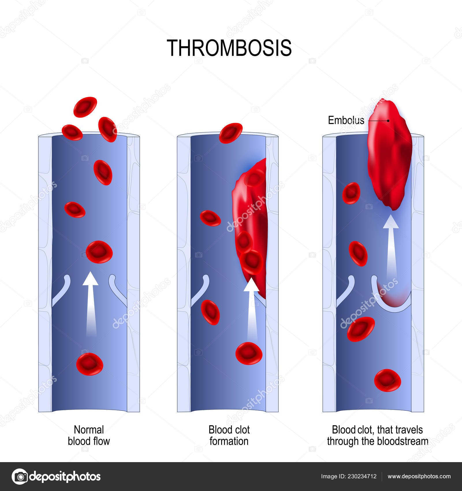 Albums 97+ Pictures Images Of Blood Clots Excellent