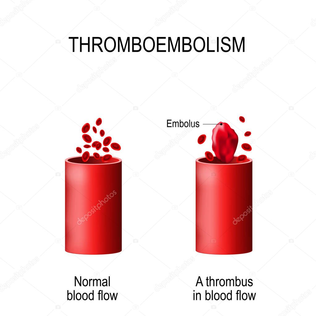 Thromboembolism. two blood vessels: normal blood flow and a blood vessel with a blood clot (embolus) and red blood cells. Vector illustration for biological, medical, and science use