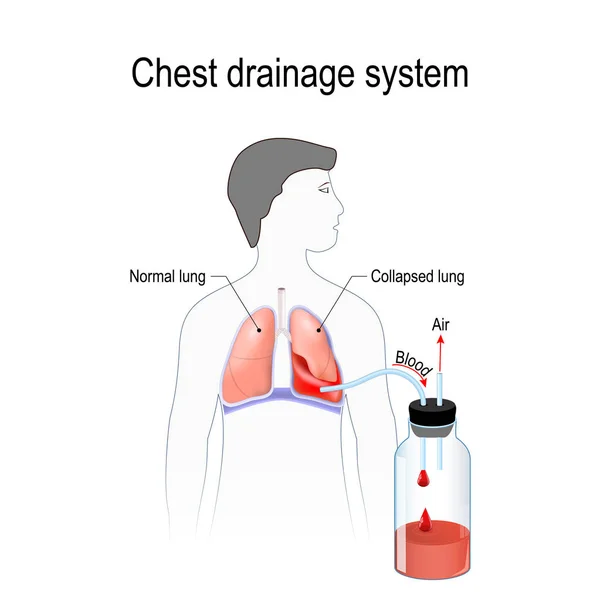 Hemotórax Colapso Pulmonar Acumulación Anormal Sangre Espacio Pleural Entre Pulmón — Vector de stock