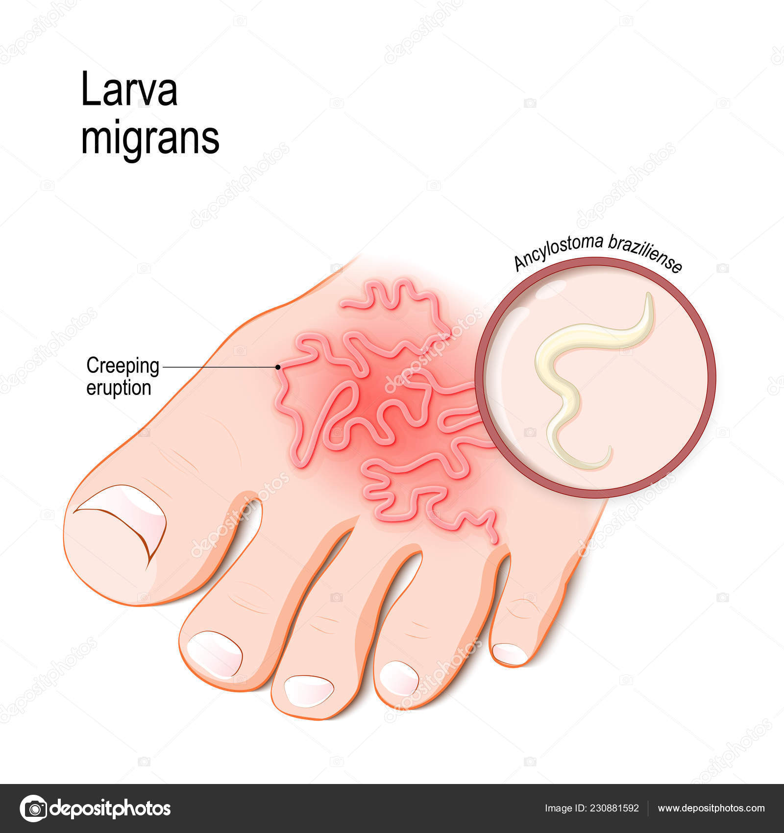 Cutaneous Larva Migrans Skin Disease Humans Caused Byhookworm Ancylostoma Braziliense Vector Image By C Edesignua Vector Stock Cutaneous Larva Migrans Skin Disease Humans Caused Byhookworm Ancylostoma Braziliense Vector Image By C Edesignua Vector Stock