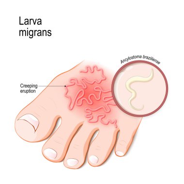 Kutanöz larva migrans. Deri hastalığı insanlarda byhookworm (kancalıkurt braziliense) neden oldu. Vektör çizim için tıp, biyoloji, bilim ve eğitim
