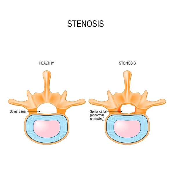 腰部脊柱管狭窄症は 脊柱管の異常狭窄です 人間の脊柱と脊髄の断面のセクション 生物学的 および教育使用のためのベクトル図 — ストックベクタ