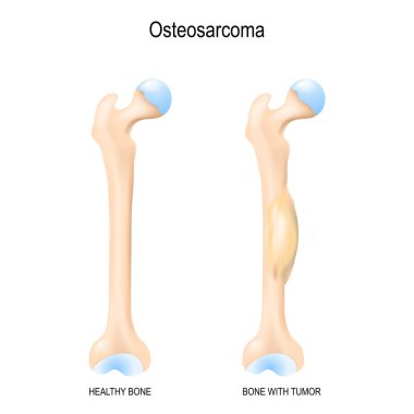 Osteosarkom. Osteojenik sarkomu bir kanserli tümör bir kemik var. malign bir neoplazma. İki insan kemikleri: sağlıklı femur ve kemik osteosarkom ile. Vektör çizim biyolojik, bilim, tıbbî kullanım için.