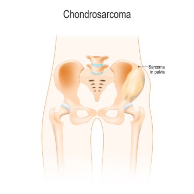 Chondrosarcoma kıkırdak hücrelerden bir kanserdir. malign bir neoplazma. Bel bölgesi. Kalça, omur ve leğen kemiği anatomisi. Vektör çizim biyolojik, bilim, tıbbî kullanım için.