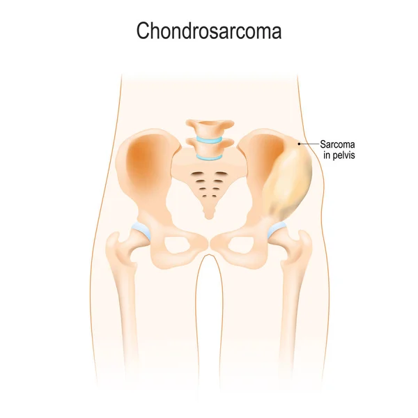 Chondrosarcoma 세포에서 암입니다 생물입니다 지역입니다 엉덩이 골반의 해부학 사용에 일러스트 — 스톡 벡터
