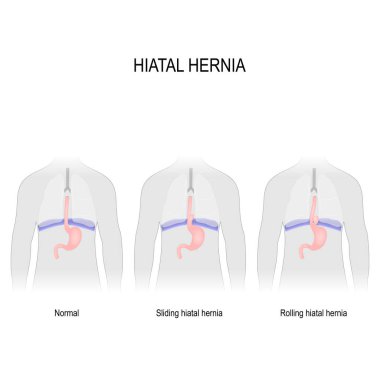 Hiatal hernia. Vector diagram of different types of hiatus hernia. Normal anatomy, sliding hiatal hernia, and rolling (paraesophageal) type of hernia. illustration for biological, science, medical use. clipart