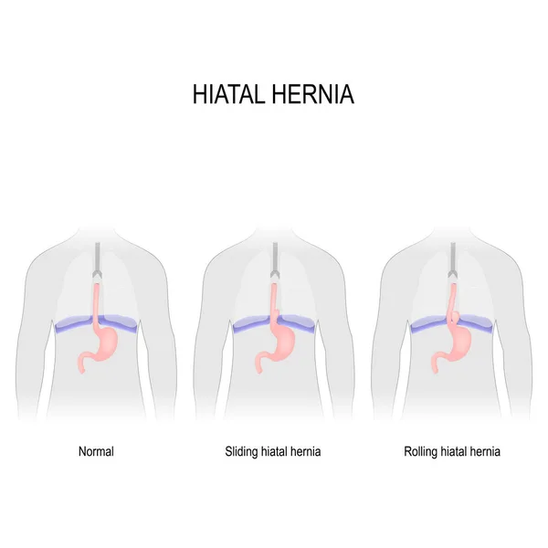 食道裂孔ヘルニア 食道裂孔ヘルニアのさまざまな種類のベクトル図です 正常解剖学 食道裂孔ヘルニアをすべりと転がり 傍食道 ヘルニアのタイプ 医療用のイラスト — ストックベクタ