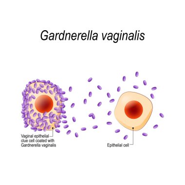 Gardnerella vajinalis. Genital enfeksiyonu. Vajinal epitel ipucu hücre bakteri ile kaplı. bakteriyel vaginosis. cinsel yolla bulaşan enfeksiyonlar. resimde biyolojik, bilim, tıbbî kullanım için.