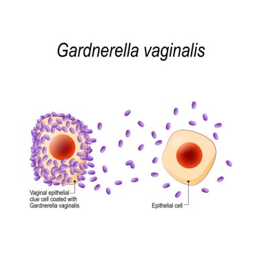 Gardnerella vaginalis. Genital infection. Vaginal epithelial clue cell coated with bacteria. bacterial vaginosis. sexually transmitted infections. illustration for biological, science, medical use. clipart