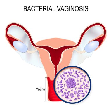 Bacterial vaginosis. Uterus and close-up of Gardnerella vaginalis (Bacteria that caused the disease). sexually transmitted infections. illustration for biological, science, medical use. clipart