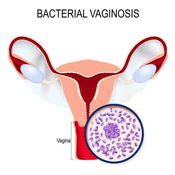 Бактериальный Вагиноз Матка Крупным Планом Gardnerella Vaginalis Бактерии Которые Вызвали — стоковый вектор