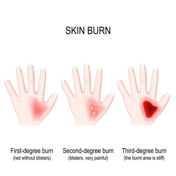 Degree Burns Skin Step Burn Human Hand Vector Illustration Biological — Stock Vector