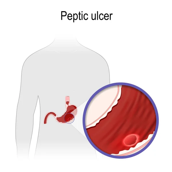Ulcera Peptica Silhouette Umana Primo Piano Stomaco Con Ulcera Ulcera — Vettoriale Stock