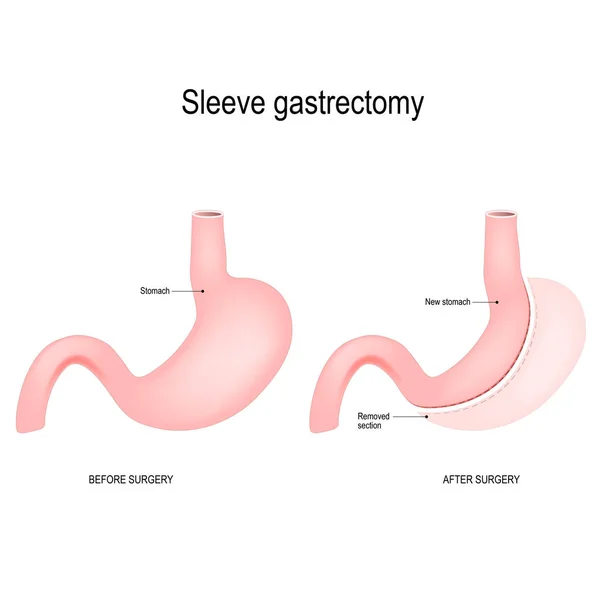 垂直袖胃切除术是一种手术减肥手术 通过手术切除大部分胃来减少胃 — 图库矢量图片