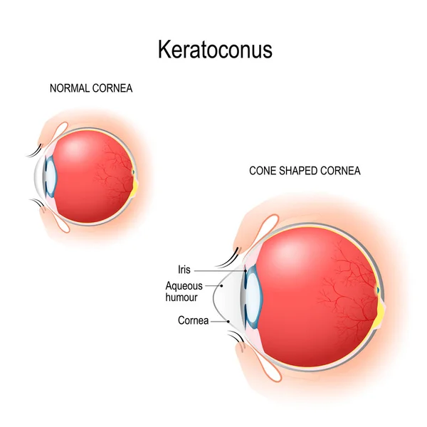 Keratoconus Normale Hoornvlies Kegel Gevormd Hoornvlies Anatomie Van Het Menselijk — Stockvector