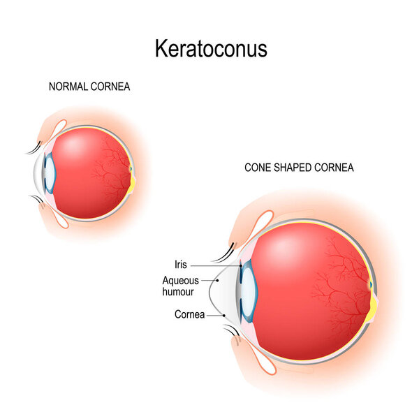 Keratoconus. Normal cornea and cone shaped cornea. Anatomy of the human eye. Vertical section of the eye and eyelids. Schematic diagram. detailed illustration. for biological, science, and medical use.