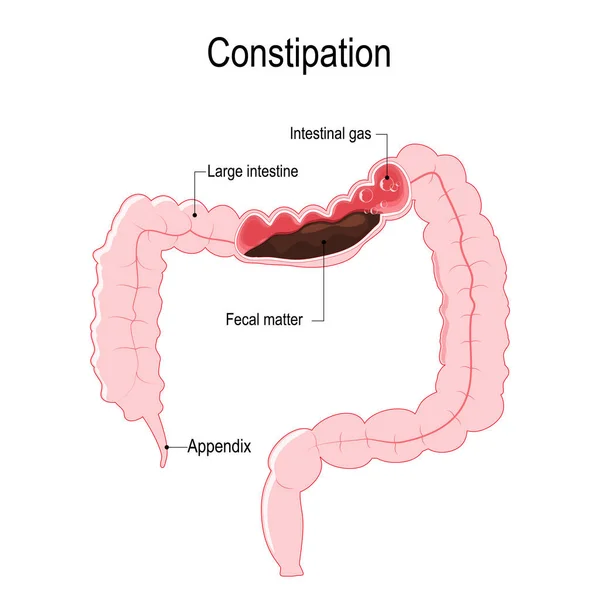 ベクトル図は 糞便と腸のガスの泡人間の大腸を表しています および医療用のイラスト — ストックベクタ