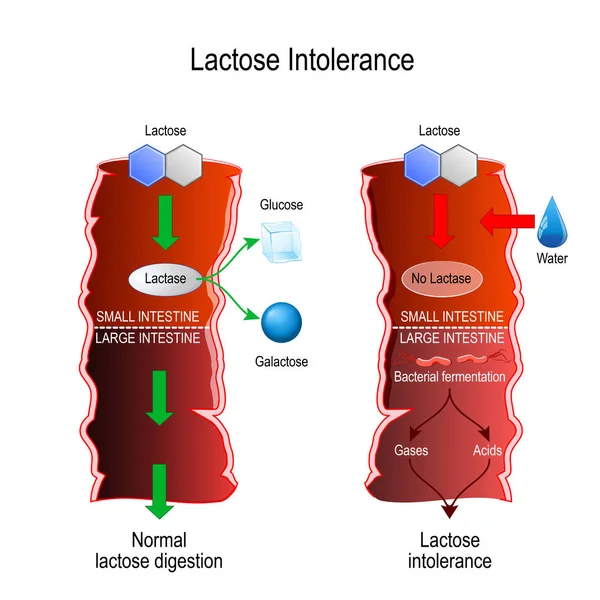 Intolerância Lactose Digestão Normal Lactose Condição Que Ser Humano Não —  Vetores de Stock