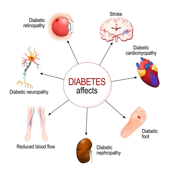 糖尿病会影响 糖尿病并发症 糖尿病足 神经病变 视网膜病变 减少血液流动和心肌病 用于教育 生物和科学用途的矢量图 — 图库矢量图片
