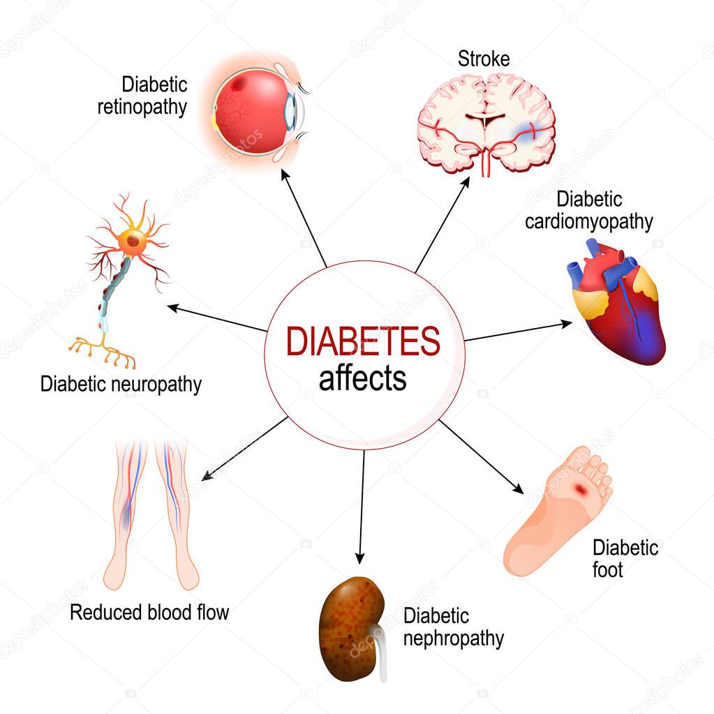 Diabetes Mellitus