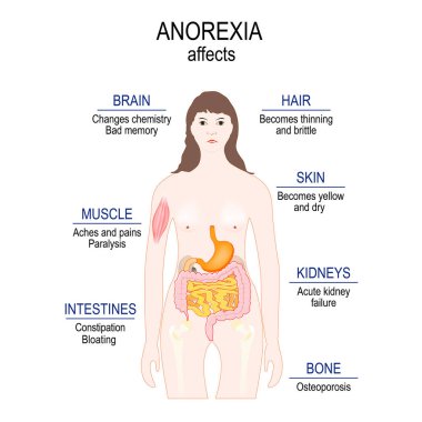 Anorexia nervosa is an eating disorder. low weight. Anorexia affects. woman silhouette with highlighted internal organs. clipart