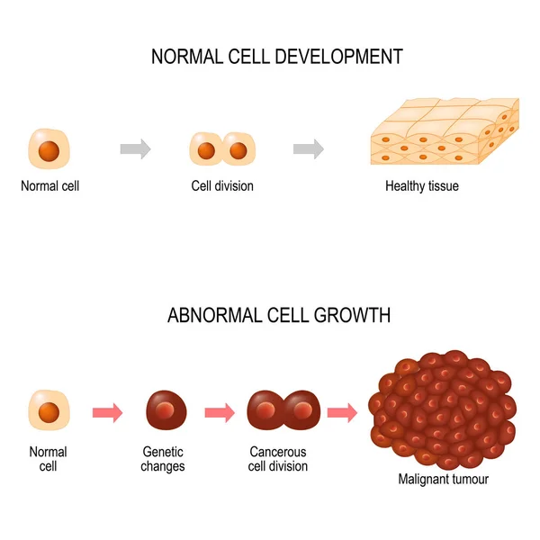 Células Cancerosas Ilustração Mostrando Desenvolvimento Doença Oncológica Tecido Saudável Tumor — Vetor de Stock