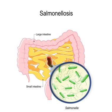 salmonelosis is salmonella poisoning from raw chicken and eggs. human intestines and bacterium that cause this disease clipart