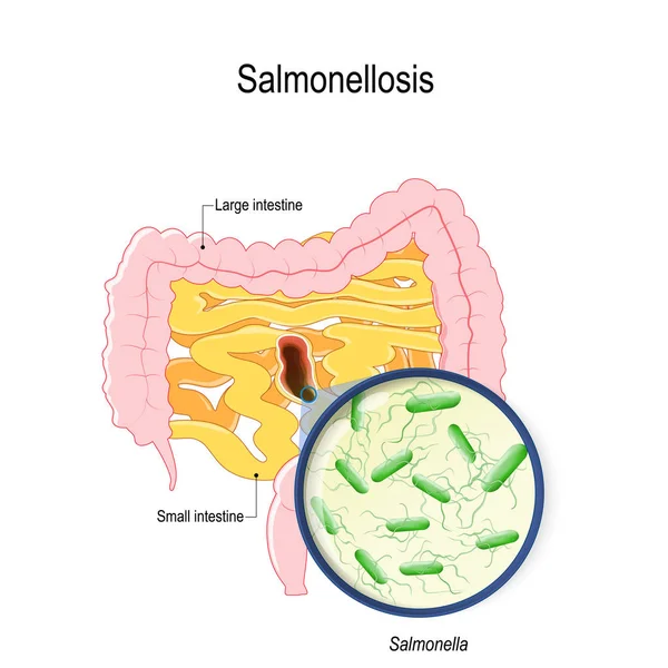 Salmonelosis Salmonella Vergiftiging Van Rauwe Kip Eieren Menselijke Darmen Bacterie — Stockvector